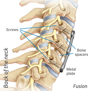 neck fusion with spacers and a plate