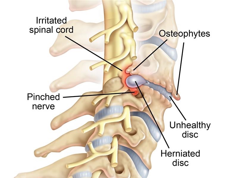 Neck Anatomy and Disease - LDR Cervical