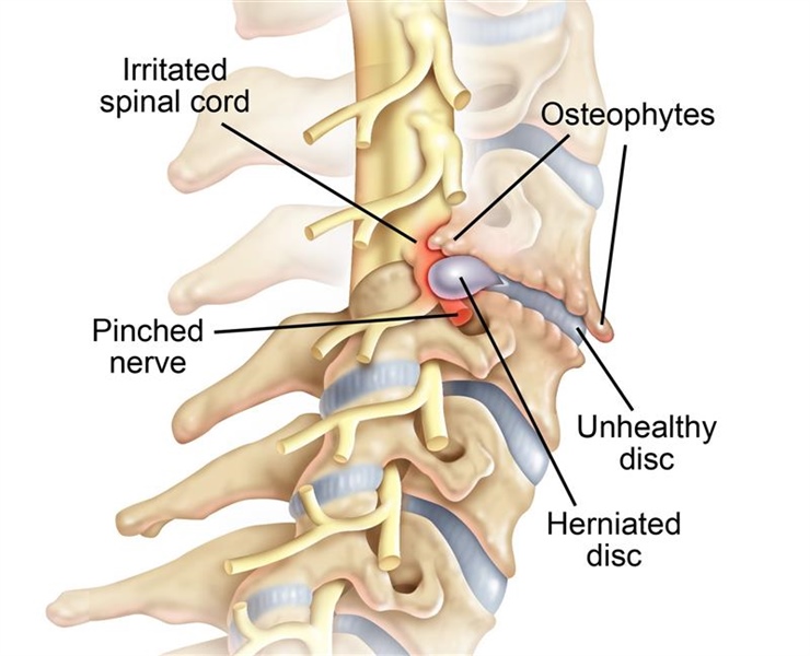 Cervical Radiculopathy Causes, Symptoms, and Treatment