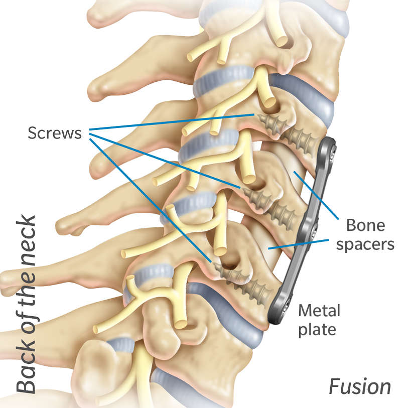 Illustrated diagram of back of the neck with a metal plate and bone spacers.