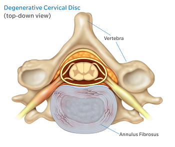 top down degenerative cervical disc